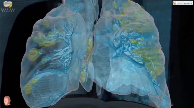 Dr. Mortman: Ovako sada izgledaju pluća koja su bila zdrava prije Covida-19